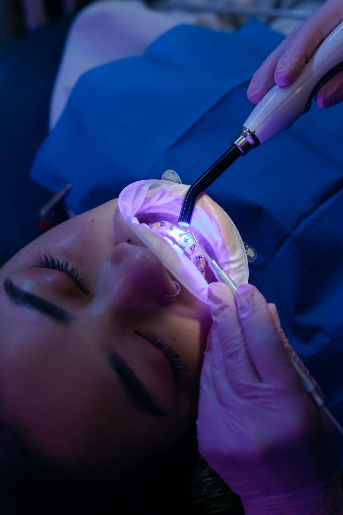 Teeth whitening treatment