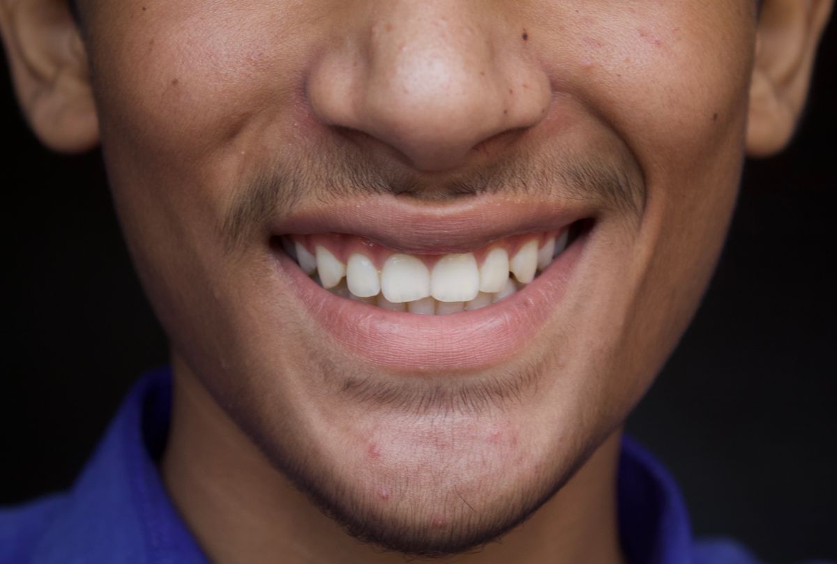Smile result 4