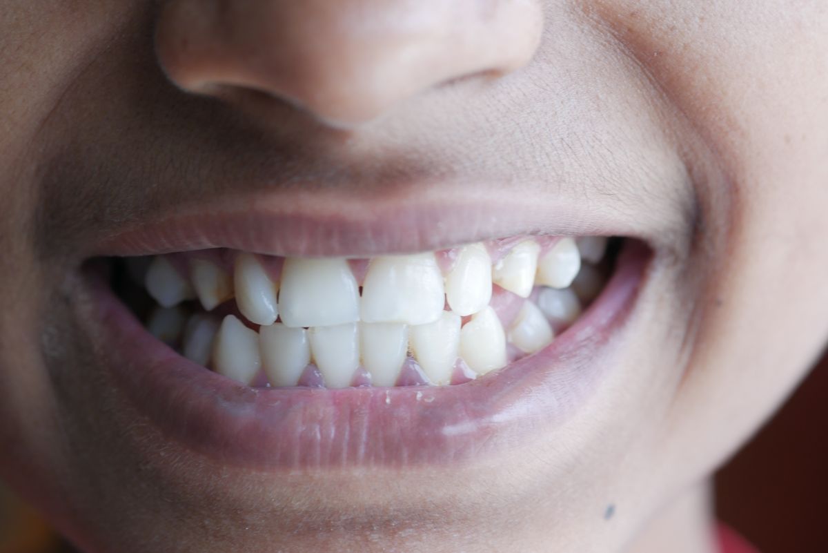 Smile result 5